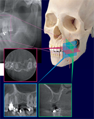 歯科用CTのメリット