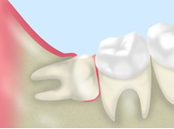 奥歯の痛み・歯ぐきの腫れを感じたら　～親知らず～